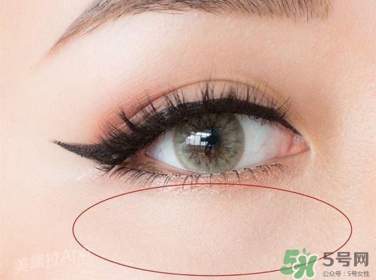 玻尿酸填充淚溝多久恢復自然？玻尿酸填充淚溝的危害