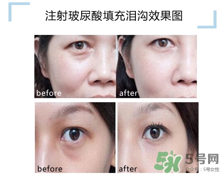 玻尿酸填充淚溝多久恢復自然？玻尿酸填充淚溝的危害