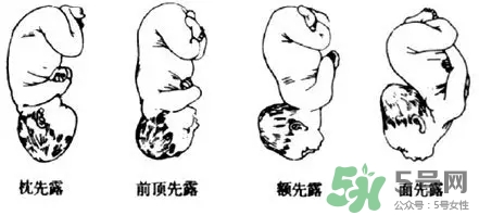 胎位不正能順產(chǎn)嗎？胎位不正怎么辦？