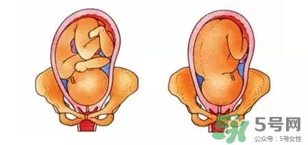 胎位不正能順產(chǎn)嗎？胎位不正怎么辦？