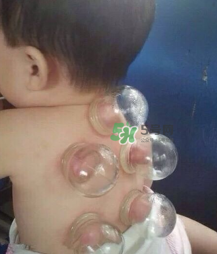 拔火罐后顏色多久消失？拔火罐印子多久能消除？