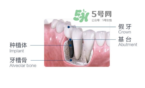 種植牙費(fèi)用多少錢？國(guó)產(chǎn)種植牙價(jià)格