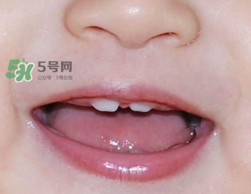 牙齒縫隙大怎么辦？牙縫大帶牙套有用嗎