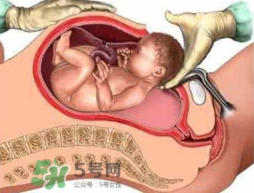 剖腹產(chǎn)比順產(chǎn)安全嗎？剖腹產(chǎn)產(chǎn)后注意事項(xiàng)？
