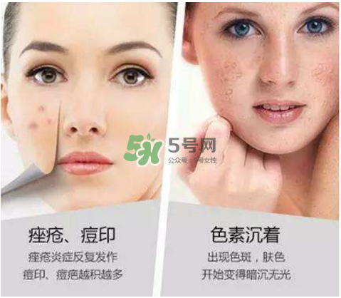 果酸換膚自己可以做嗎？果酸換膚后注意事項