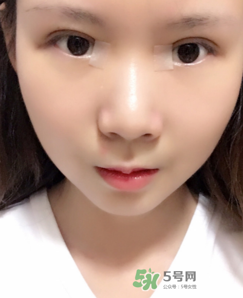美皮護(hù)去疤效果怎么樣？美皮護(hù)有用嗎？