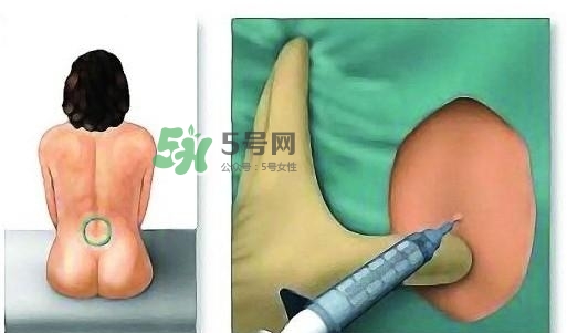 無痛分娩為什么不提倡？無痛分娩有后遺癥嗎？