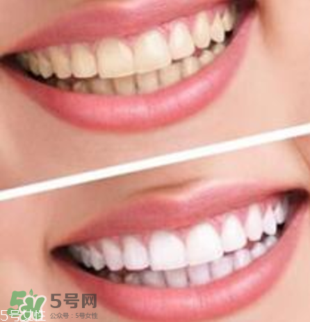 碧緹福美牙儀對牙齒有傷害嗎？碧緹福美牙儀會反彈嗎？