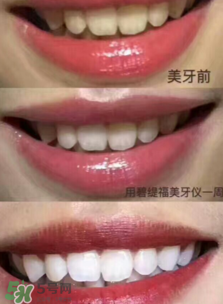 美牙儀能用水洗嗎？美牙儀能用多久？