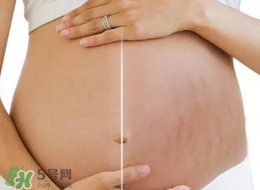 脖子上會(huì)長妊娠紋嗎？妊娠紋長在哪些地方？