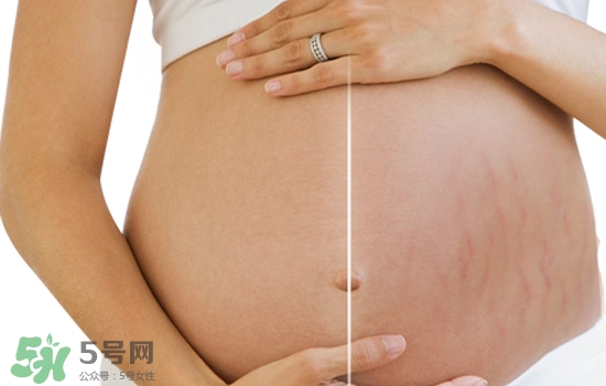 妊娠紋在左邊生男或女？怎么從妊娠紋看男女？