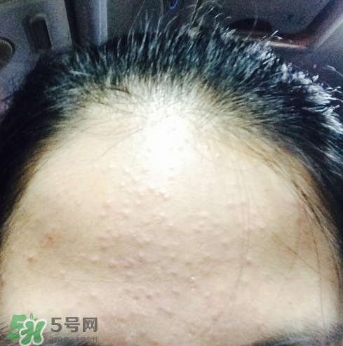 長(zhǎng)痘長(zhǎng)閉口怎么辦？長(zhǎng)痘長(zhǎng)閉口是什么原因？