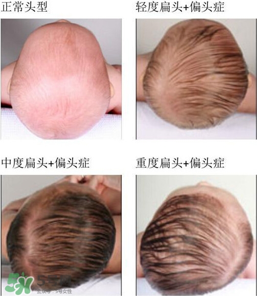 寶寶頭型是睡出來(lái)的嗎？寶寶頭型矯正最佳時(shí)間