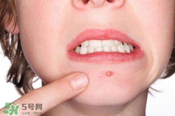 暗瘡可以擠壓嗎？油性和骯臟肌膚會容易有暗瘡嗎？