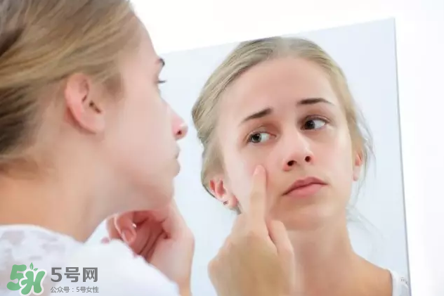 暗瘡可以擠壓嗎？油性和骯臟肌膚會容易有暗瘡嗎？