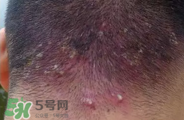痤瘡和毛囊炎一樣嗎？痤瘡與毛囊炎區(qū)別