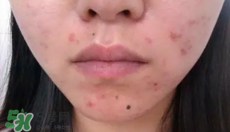 痤瘡和毛囊炎一樣嗎？痤瘡與毛囊炎區(qū)別
