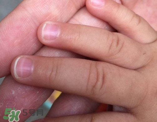 寶寶手指甲有白痕怎么回事？幼兒手指甲發(fā)白是缺鈣嗎