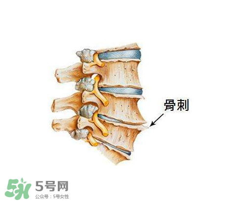 骨刺是怎么形成的？骨刺怎么治療？
