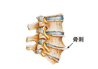 骨刺是怎么形成的？骨刺怎么治療？