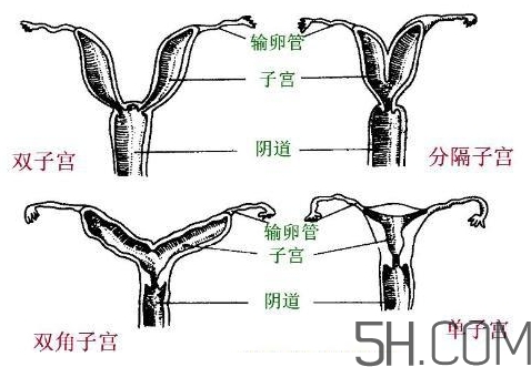 子宮畸形有哪些？子宮畸形有什么影響？