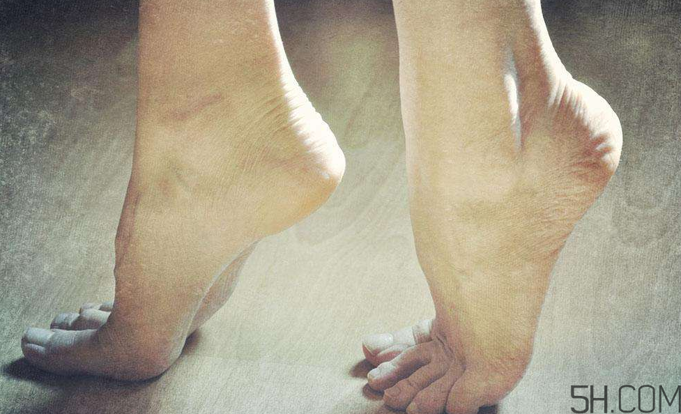 腳氣是什么原因引起的？腳氣是濕氣重引起的嗎?