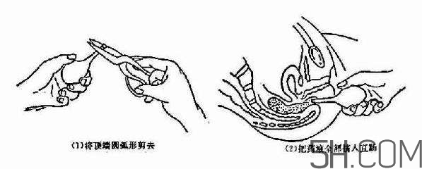 開塞露怎么用？開塞露用后多久會排便？