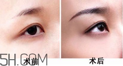 切眉手術后老得快嗎？切眉能保持多久？