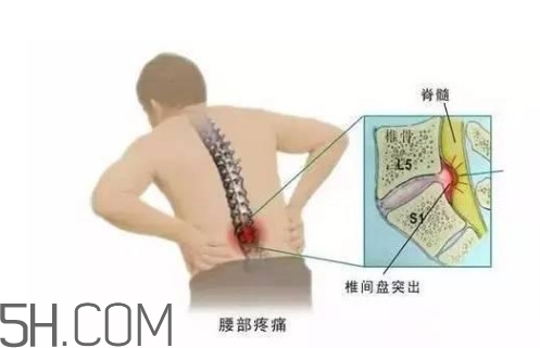 腰間盤(pán)突出是什么原因引起的？腰間盤(pán)突出是腎虛嗎