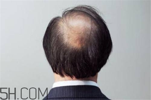 為什么男性比女性更容易脫發(fā)？什么原因?qū)е履行悦摪l(fā)？