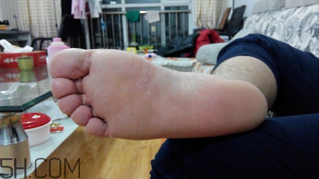 腳氣可以用酒精消毒嗎？腳氣可以用碘伏消毒嗎？