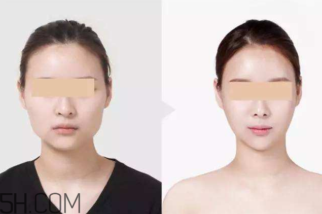 打瘦臉針可以抽煙嗎？打瘦臉針會反彈嗎？