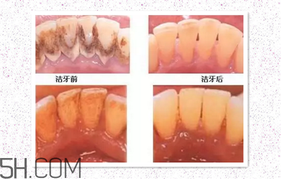 超聲波洗牙可以美白牙齒嗎？超聲波洗牙多少錢一次？