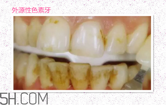 超聲波洗牙可以美白牙齒嗎？超聲波洗牙多少錢一次？