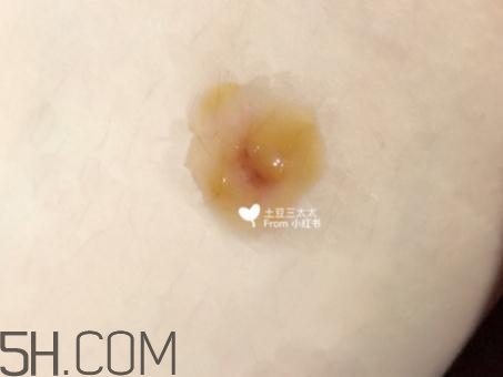 美寶濕潤燒傷膏怎么樣？美寶濕潤燒傷膏有用嗎？