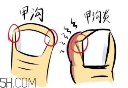 為什么容易得甲溝炎？怎么根治甲溝炎？