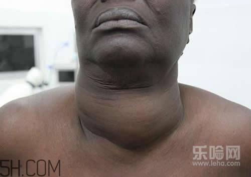 甲狀腺腫大和甲亢的區(qū)別有哪些？甲狀腺腫大適合吃什么食物？