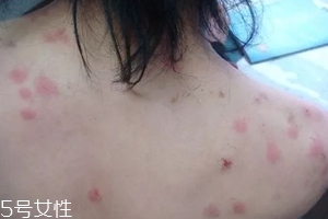 螨蟲有哪些危害？嚴(yán)重時(shí)肌膚糜爛