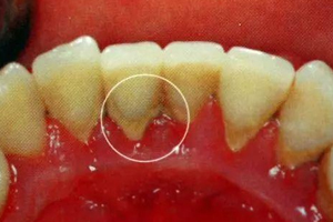 牙結(jié)石能自動(dòng)脫落嗎？除了洗牙別無(wú)他法