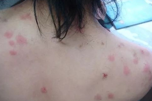 螨蟲有哪些危害？嚴(yán)重時(shí)肌膚糜爛