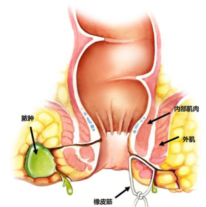 肛瘺非手術(shù)治療才可以嗎？手術(shù)是治療的關(guān)鍵途徑