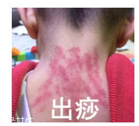 吮痧有什么療效？最溫柔的治病方法