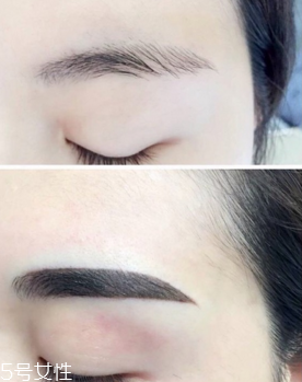 激光洗眉恢復(fù)期有疤痕怎么辦？激光洗眉毛之后正確護(hù)理方法