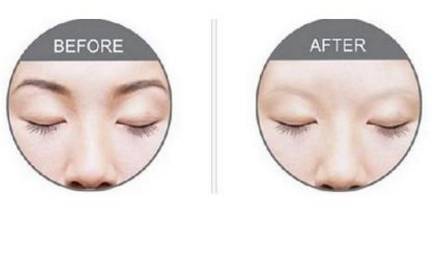 激光洗眉恢復(fù)期有疤痕怎么辦？激光洗眉毛之后正確護(hù)理方法