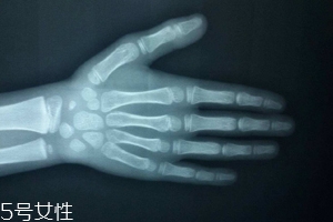 哪些人需要測骨齡？長太快警惕骨齡提前