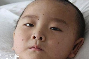 痣什么情況下會(huì)轉(zhuǎn)變?yōu)榱?？點(diǎn)痣不可取