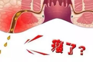 肛瘺非手術(shù)治療才可以嗎？手術(shù)是治療的關(guān)鍵途徑