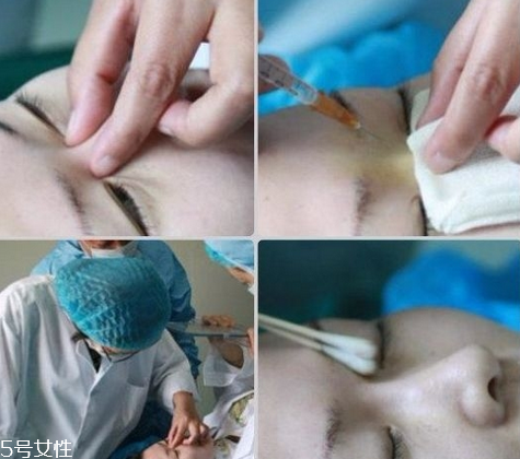 玻尿酸隆鼻維持時(shí)間受什么影響？玻尿酸不能過(guò)度注射