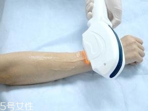 激光脫毛需要幾次？激光脫毛并不是終身有效的