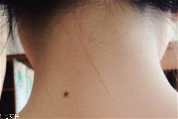 脖子后面有痣好嗎？激光冷凍祛痣易導(dǎo)致癌變